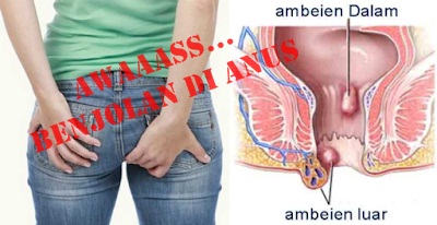Obat Benjolan Pada Bibir Anus Tapi Tidak Sakit Yang Manjur