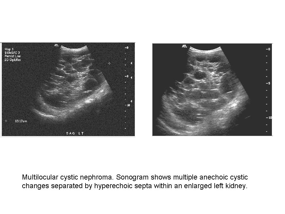 BÀI SOẠN VỀ SIÊU ÂM CHẨN ĐOÁN: NHÂN CA MULTILOCULAR CYSTIC RCC tại MEDIC