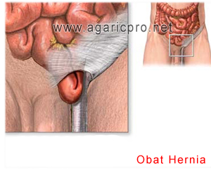 Obat Hernia Tradisonal Paling Paten Dalam Menaklukan Hernia Obat Hernia Tradisonal Paling Paten Dalam Menaklukan Hernia