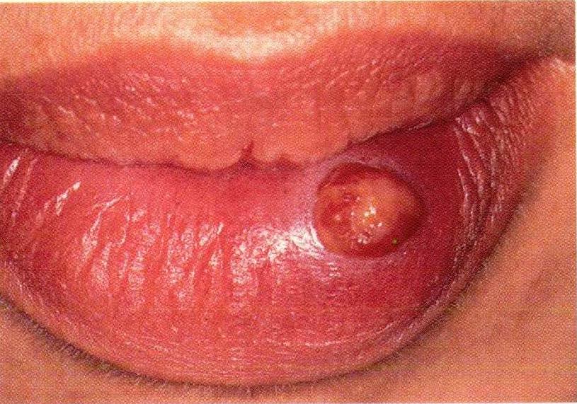 What Are the Causes of Lip Lesions? (with pictures)