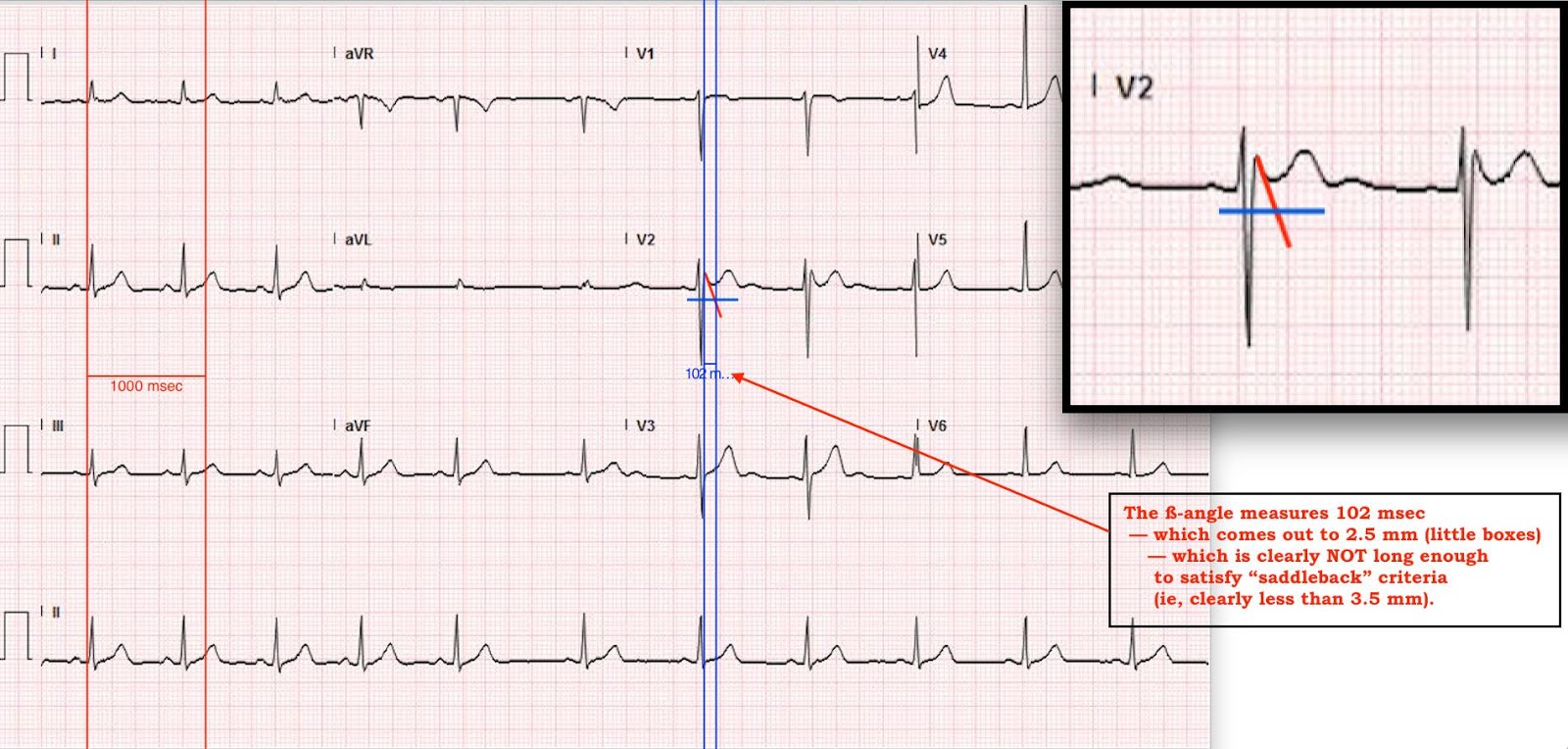 Dr. Smith's ECG Blog NonVagal Syncope and Saddleback Morphology in V2