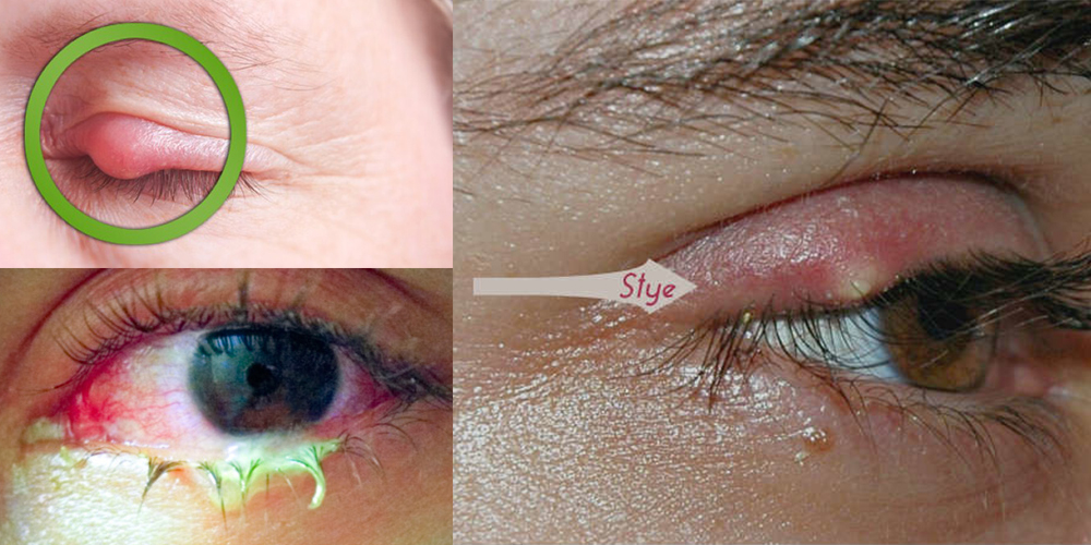 natural-remedies-for-eyes-infection-2016-life-with-styles