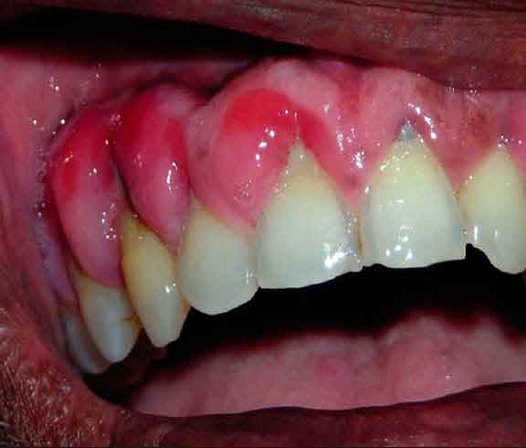 Hiv infection oral sex studies Hiv infection oral sex studies