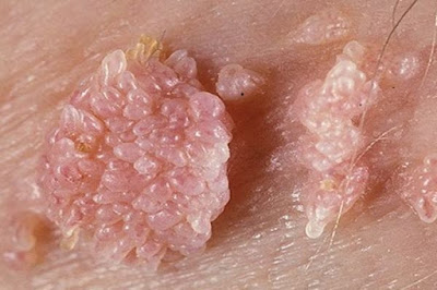 Foto CARA HERBAL MENGOBATI HPV KUTIL KELAMIN PADA PRIA DAN WANITA