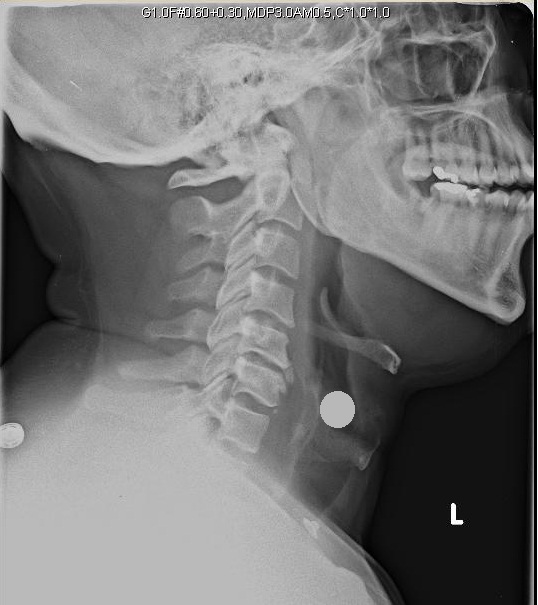 ENT for medical students ENT PICTURES LARYNX