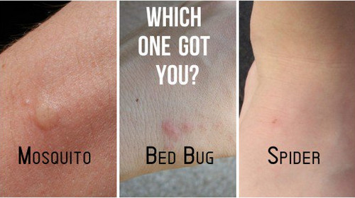 I Think I Have A Bed Bug Bite I Think I Have A Bed Bug Bite