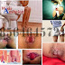 Hemoroid (Wasir)?? Jangan Buru-Buru Suntik thumbnail
