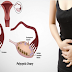 Top 5 Home Remedies For Polycystic Ovary Syndrome (PCOS)
