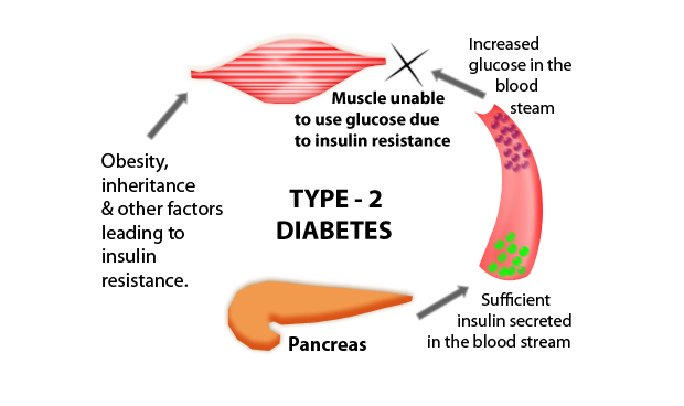 Diabetes Mellitus Type 2 Symptoms, Causes, and Treatment
