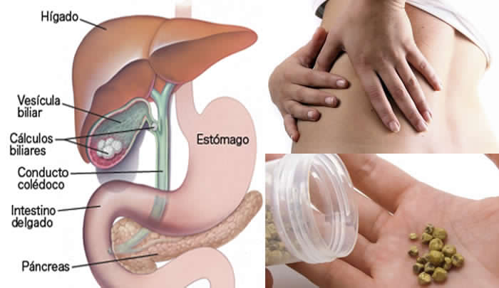 Inflamacion de la vesicula biliar sin calculos