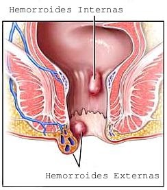 cancer de colon y hemorroides