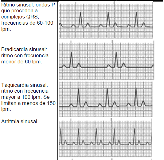 Blog De todo: LAS PRINCIPALES ARRITMIAS EN ELECTROCARDIOGRAMA