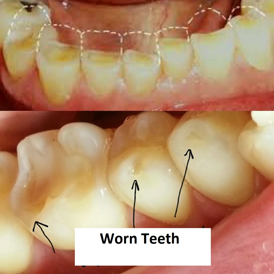 HOW TO STOP GRINDING YOUR TEETH