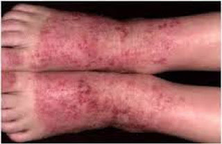 Obat eksim parah Obat eksim parah