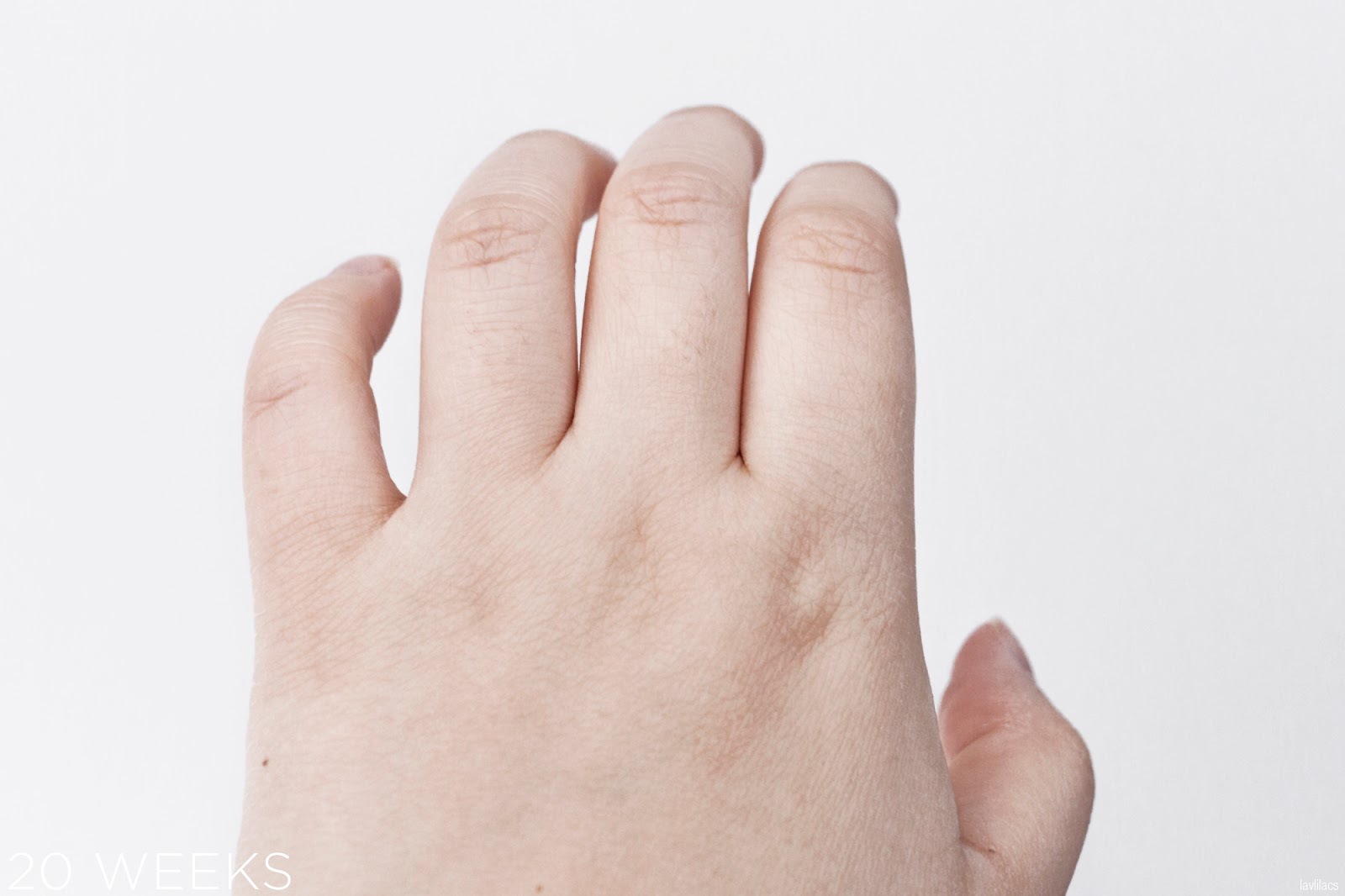tria Hair Removal Laser Knuckle Hair 20 Weeks