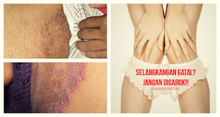 obat gatal paling manjur atasi gatal di selangkangan sembuh total obat gatal paling manjur atasi gatal di selangkangan sembuh total