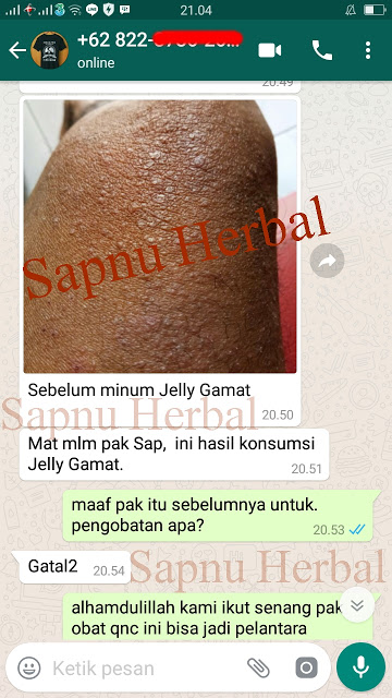 Obat Infeksi Bekas Jahitan Operasi Tradisional yg TERBUKTI Manjur!!