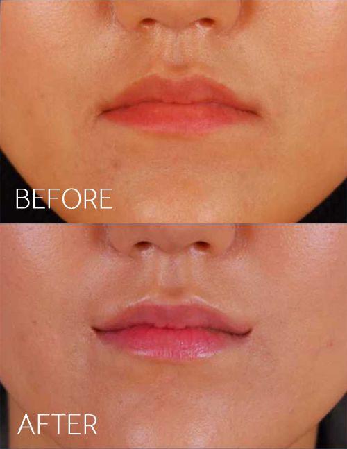 surgery plastic smile korea south permanent corner carotid mouth artery trending unsatisfied ed lift crossword times necklines droopy indicate arteries