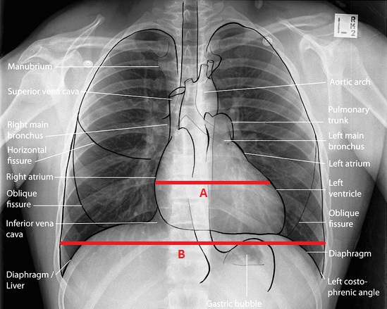 MBBS DOCTORS: Basics of Reading Chest X ray diagram of radiography machine 