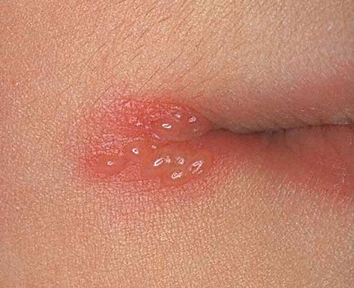 vaginal sores yeast Big boob milf webcam