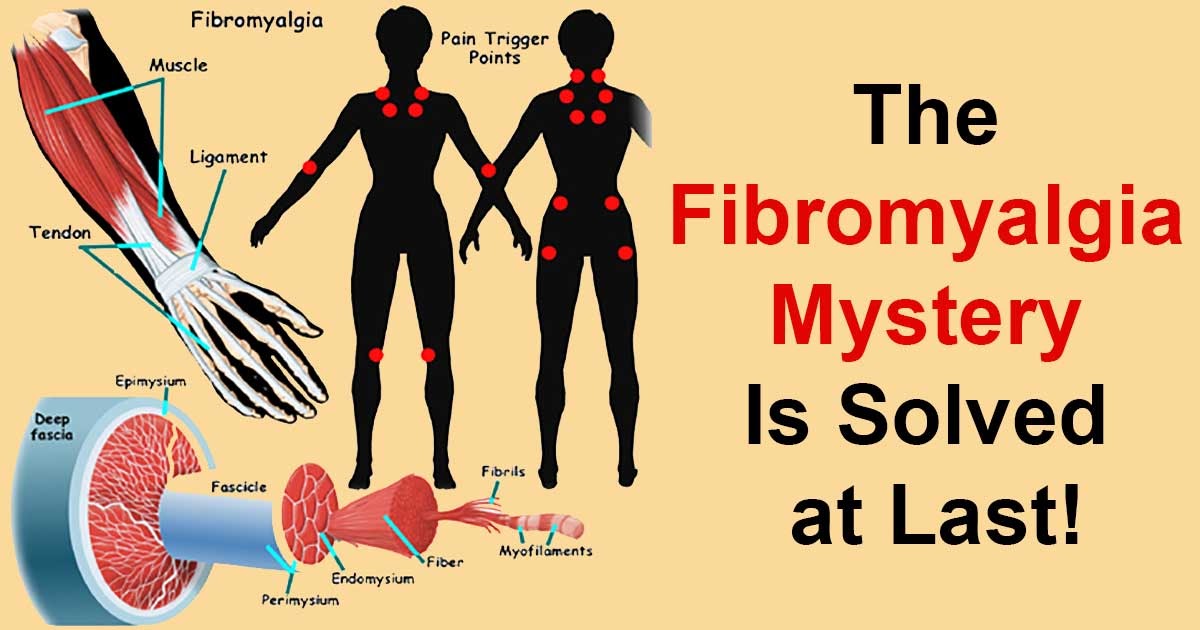 Фибромиалгия лечение симптомы причины заболевания. Фибромиалгия. Фибро алгия. Фибромиалгия / Fibromyalgia.