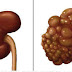 IF YOU WANT TO PROTECT YOUR KIDNEYS DON’T DO THIS