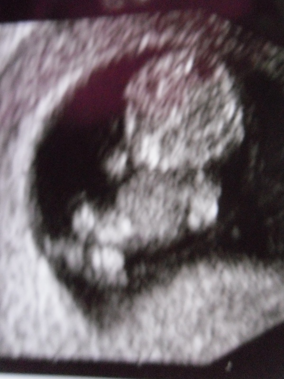 My Pregnancy Peanut at 9 weeks and 4 days )