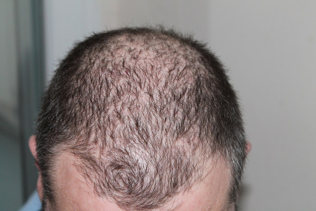 male pattern baldness male pattern baldness