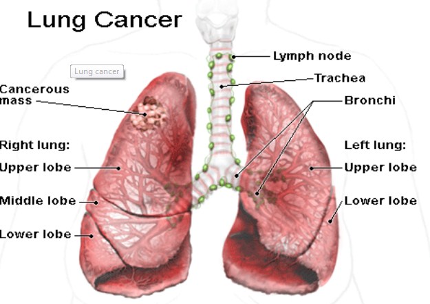 Lung Clevercer Causes, Symptoms And Treatment Lung Clevercer Causes, Symptoms And Treatment