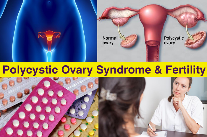 The Imbalance In Female Hormones May Prevent Ovulation Leading To