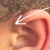 Preauricular Sinus: Ini Sebab Mengapa Sesetengah Orang Mempunyai Lubang Kecil Di Atas Telinga Mereka