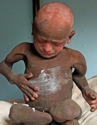 مرض نادر، تمثال حجري، عجائب وغرائب