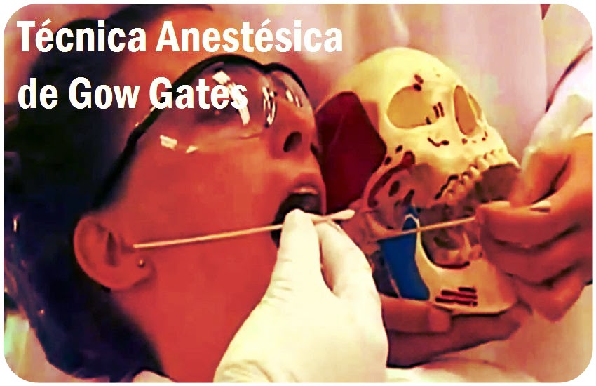 ANESTESIA DENTAL Técnica anestésica de Gow Gates OdontoTv