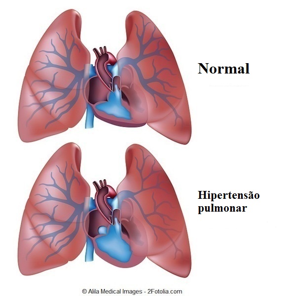 Embolia Pulmonar O Que é, e Como Se Proteger! Saúde & Conhecimento Embolia Pulmonar O Que é, e Como Se Proteger! Saúde & Conhecimento