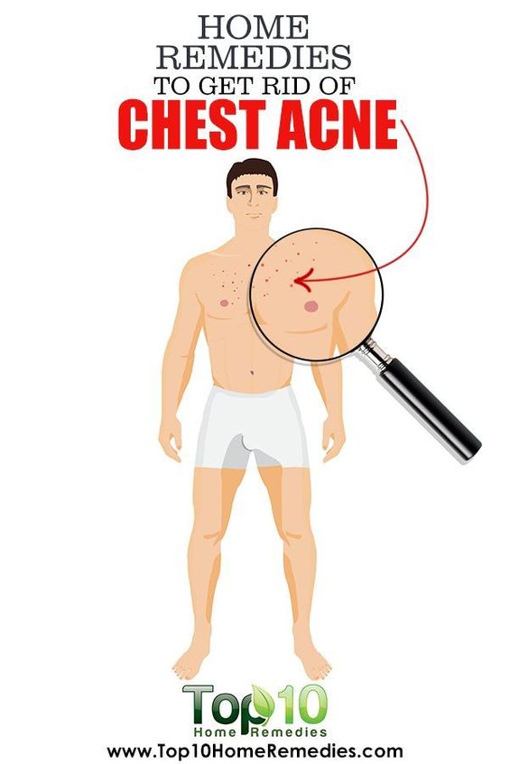 Home Remedies To Get Rid of Chest Acne