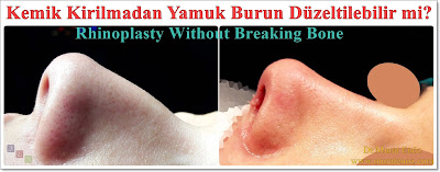 Yamuk burun tedavisi - Eğri burun tedavisi - Eğik burun ameliyatı - Kemik kırmadan burun estetiği - Burun ucu estetiği - Burun kemeri törpüleme - Kıkırdak macunu ile yamuk burun düzeltme - Eğri burun ameliyatı izle - Yamuk burun ameliyatı - Burun ucu ameliyatı - Rhinoplasty without breaking bone - Rhinoplasty in istanbul - Tip plasty in istanbul Yamuk burun tedavisi - Eğri burun tedavisi - Eğik burun ameliyatı - Kemik kırmadan burun estetiği - Burun ucu estetiği - Burun kemeri törpüleme - Kıkırdak macunu ile yamuk burun düzeltme - Eğri burun ameliyatı izle - Yamuk burun ameliyatı - Burun ucu ameliyatı - Rhinoplasty without breaking bone - Rhinoplasty in istanbul - Tip plasty in istanbul