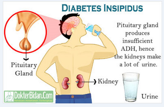 Diabetes Insipidus - Penyebab, Gejala, Pencegahan Komplikasi dan Pengobatanya Diabetes Insipidus - Penyebab, Gejala, Pencegahan Komplikasi dan Pengobatanya