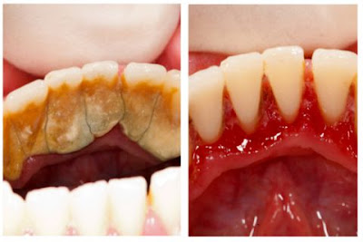  Quy trình cạo vôi răng tại nha khoa