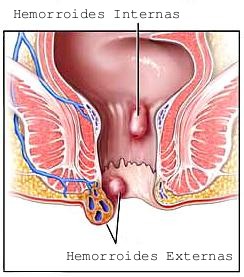 detener-dolor-de-hemorroides
