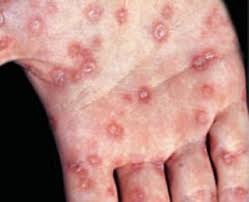 Binotal Obat Kencing Nanah