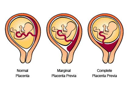 Low Lying Placenta (Placenta Previa) Healthline - marginal placenta previa