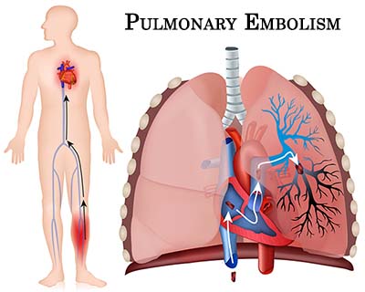 Pulmonary Embolism Air Travel Pulmonary Embolism Air Travel