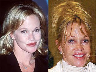 Melanie Griffith Face Lift