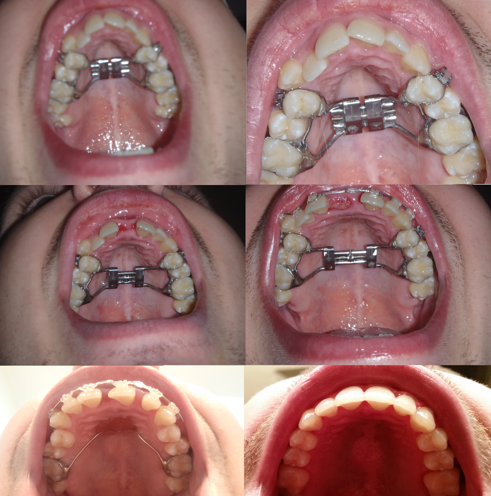 My SARPE Story From Start to Finish