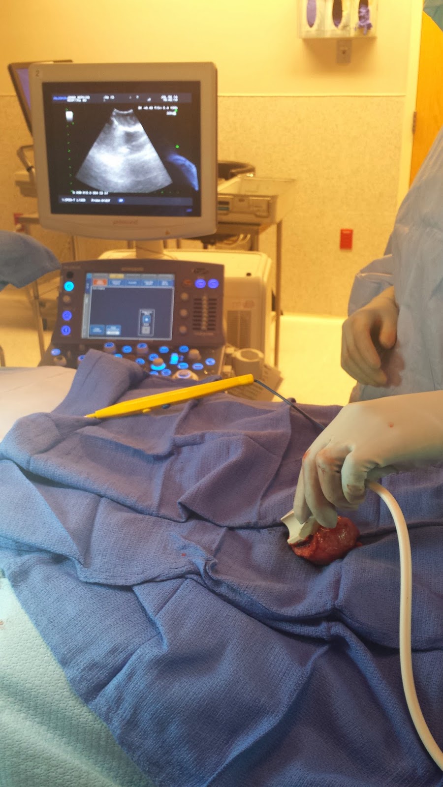 Cancer Remedy Surgery for Testicular Cancer Orchiectomy