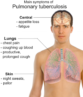 Pulmonary-tuberculosis-symptoms