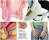 Image Apa Perbedaan Ambeien, Wasir Dan Hemoroid ?