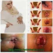 Image Cara Hilangkan Wasir Atau Ambaian Tanpa Operasi