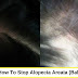 How To Stop Alopecia Areata (Bald Patches) Home Remedies | Healthy Facts