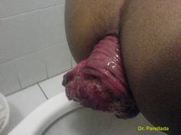 hemorroides sexo anal